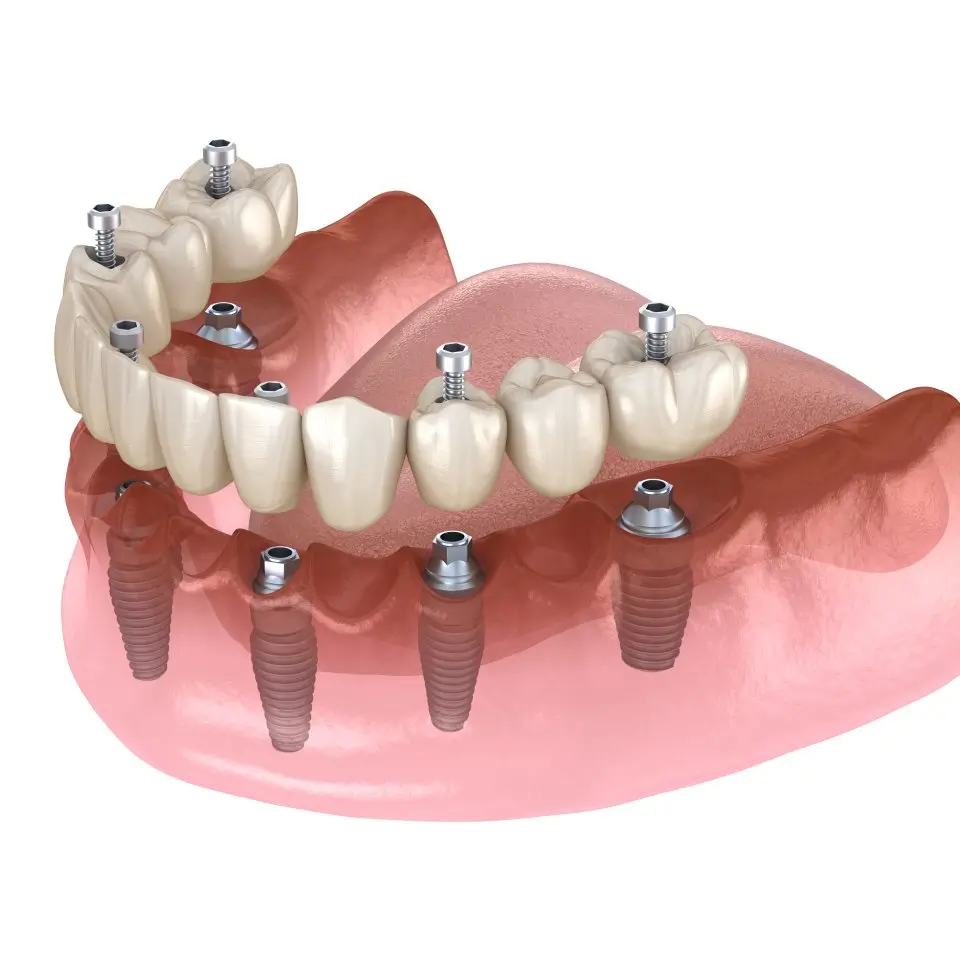 Overdentures