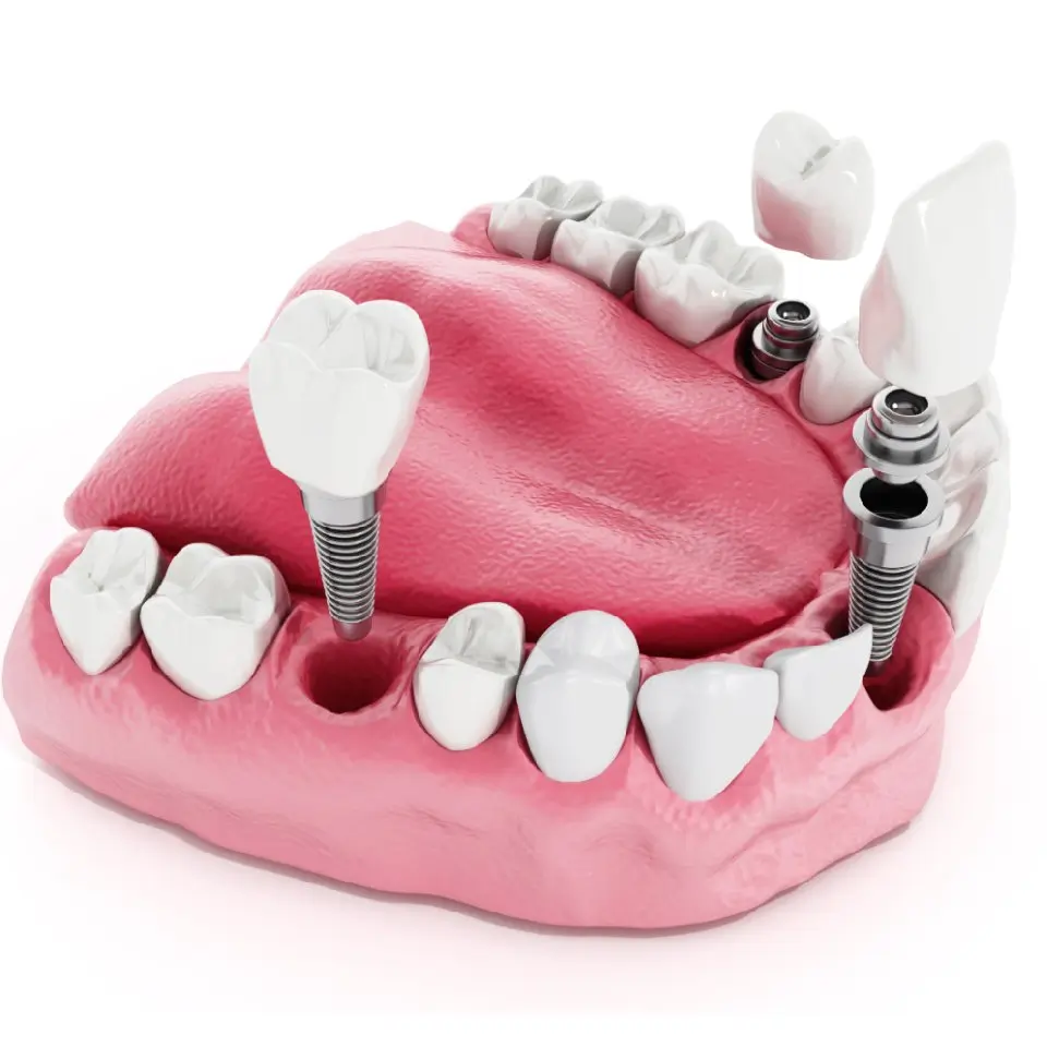 Multiple Implants for Full Mouth Reconstruction