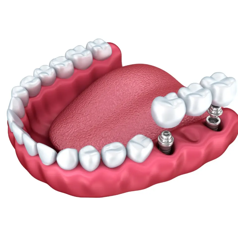 Implant Supported Bridge