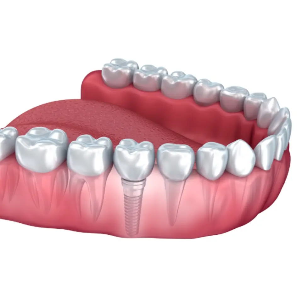 Single-Tooth Implant