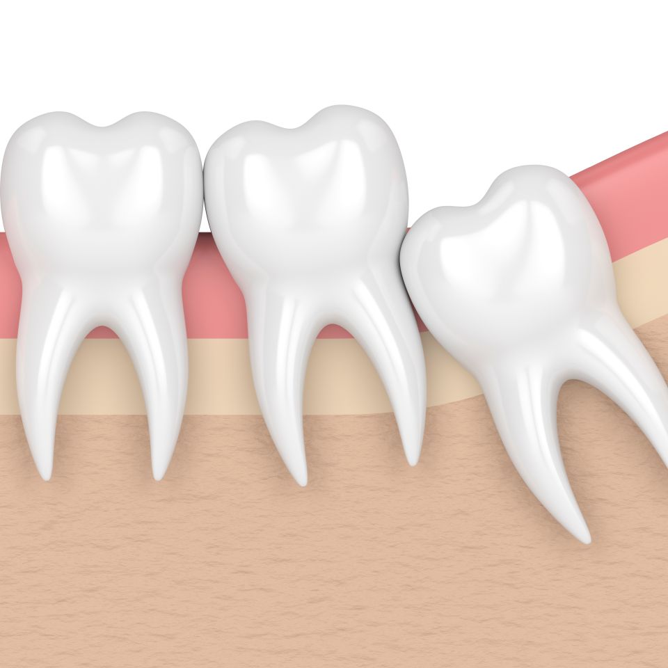 Illustration showing an impacted wisdom tooth pressing against a neighboring molar beneath the gum line.